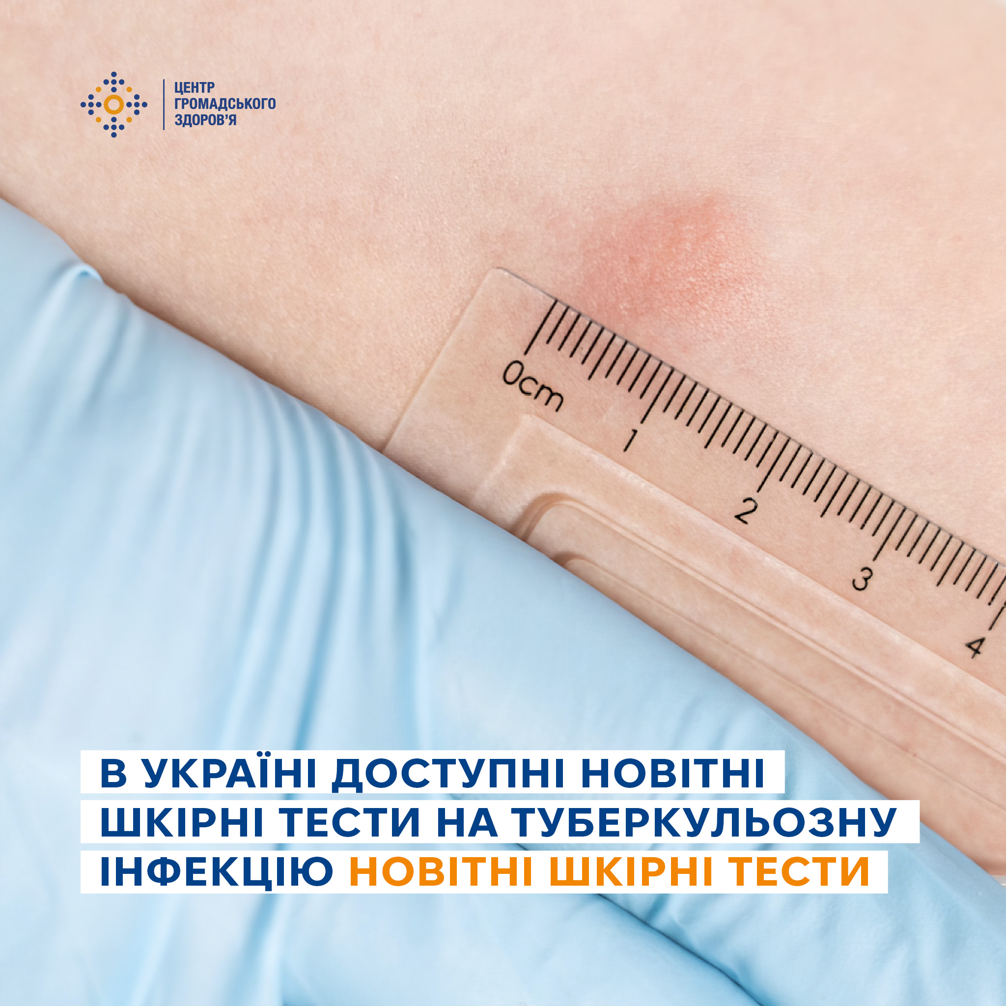 В Україні активно впроваджуються нові шкірні тести для виявлення туберкульозної інфекції (ТБ-інфекція)